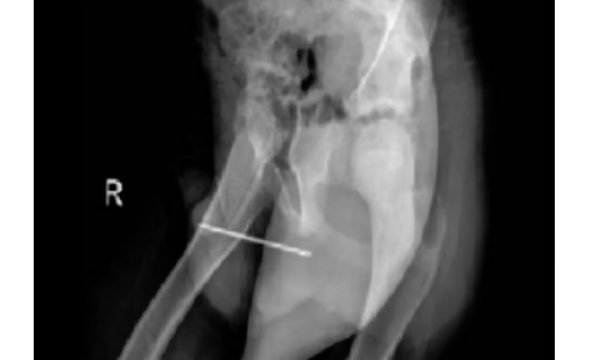 Doktorët largojnë gjilpërën 8 centimetra nga organi gjenital i një 11 vjeçari